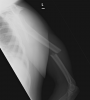 arm xray - Copy.png